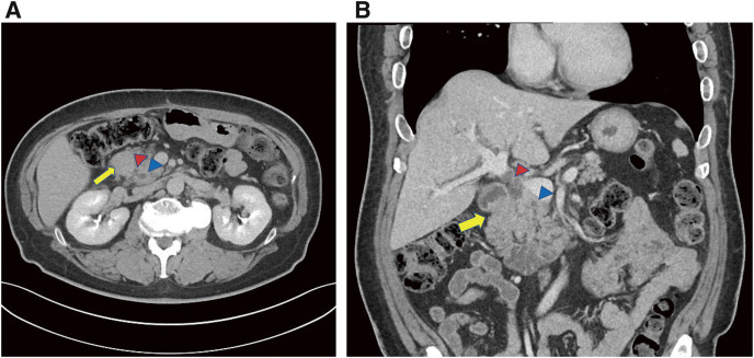A Rare Case of Ampullary Carcinoma with Complete Duodenal Obstruction as the Initial Manifestation.