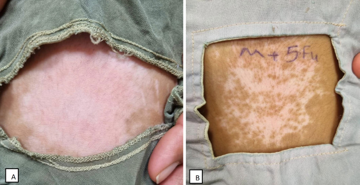Enhancing Repigmentation in Vitiligo: A Comparative Clinical Trial of Microneedling with Topical 5-Fluorouracil, Fluocinolone, and Microneedling Alone.