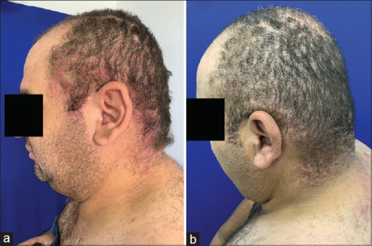 Refractory Folliculitis Decalvans: New Therapeutic Horizons?