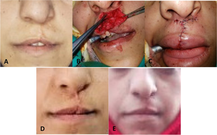 Treatment outcomes of two surgical techniques in secondary reconstruction of unilateral cleft lip and ala nasi utilizing anthropometry assessment: a randomized controlled trial.