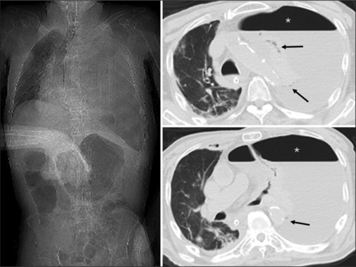 Case of Cardiac Arrest due to Pyopneumothorax.