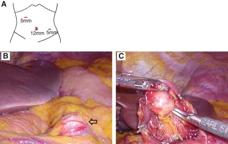 Laparoscopic Resection of an Unruptured Aneurysm of the Right Gastric Artery.