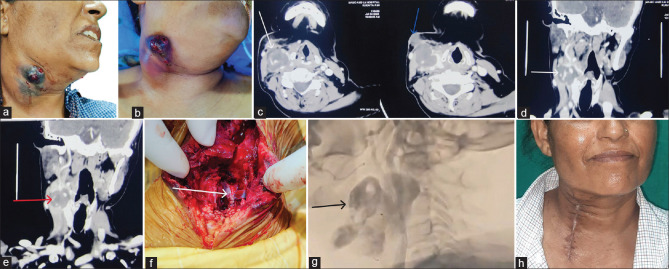 Lemierre's Syndrome Complicated by Common Carotid Artery Pseudoaneurysm with Sentinel Bleed - A Case Report.