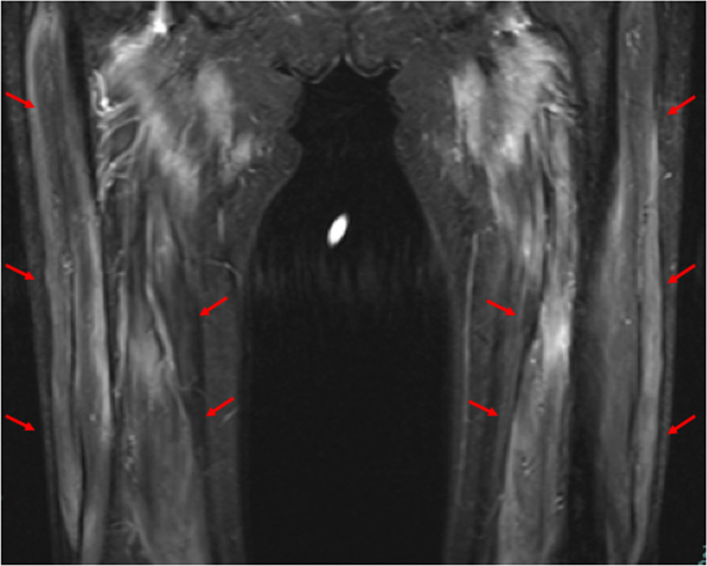 Refractory Severe Anti-SRP Myopathy that Improved with Long-term Rehabilitation Therapy: A Case Report.