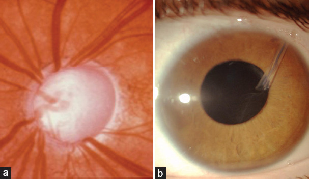 Juvenile idiopathic arthritis and associated uveitis: A review of pathogenesis, diagnosis, and management.