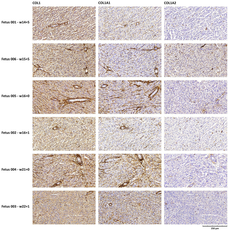Case Series of 6 Fetuses With Osteogenesis Imperfecta Type II: A Retrospective Study of Heart Pathology.