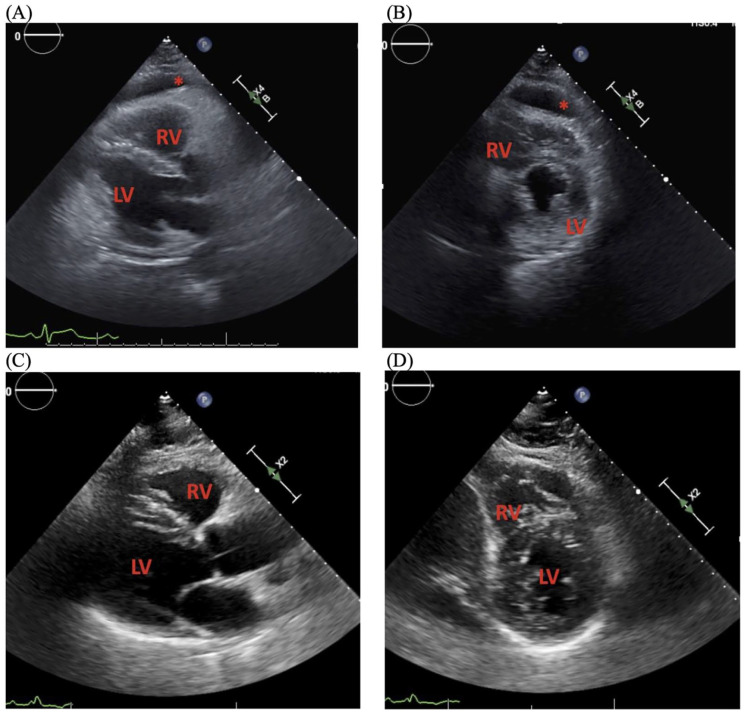Streptococcal Pharyngitis Complicated by Clinically Significant Rheumatic Myopericarditis: A Case Report.