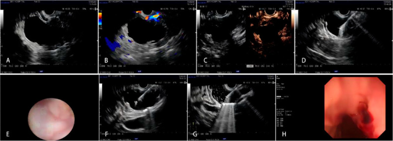 EUS-guided lauromacrogol ablation with different concentrations of lauromacrogol for the treatment of pancreatic cystic neoplasm: A randomized controlled study.