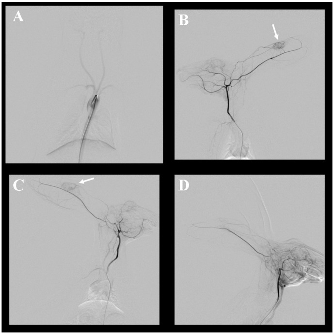 Feasibility of rabbit auricular VX2 tumor model as an experimental model for intra-arterial embolization.