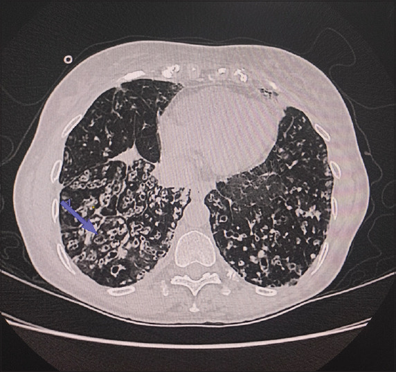 Pulmonary talaromycosis in a non-HIV individual-A rare case report from Southern India.