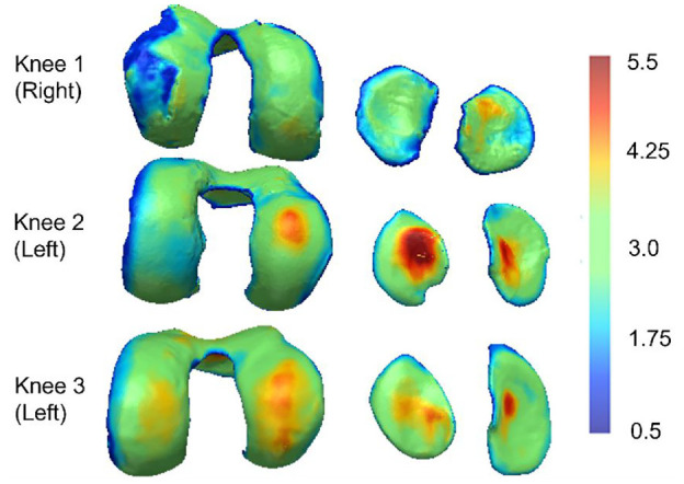 The role of high-resolution cartilage thickness distribution for contact mechanics predictions in the tibiofemoral joint.