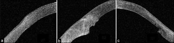 Assessing the Relationship between Graft-Host Junction Profile and Corneal Astigmatism and Higher-Order Aberrations in Postpenetrating Keratoplasty Eyes.