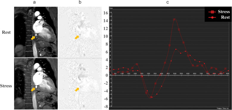 Microvascular Dysfunction in Patients with Idiopathic Dilated Cardiomyopathy: Quantitative Assessment with Phase Contrast Cine MR Imaging of the Coronary Sinus.