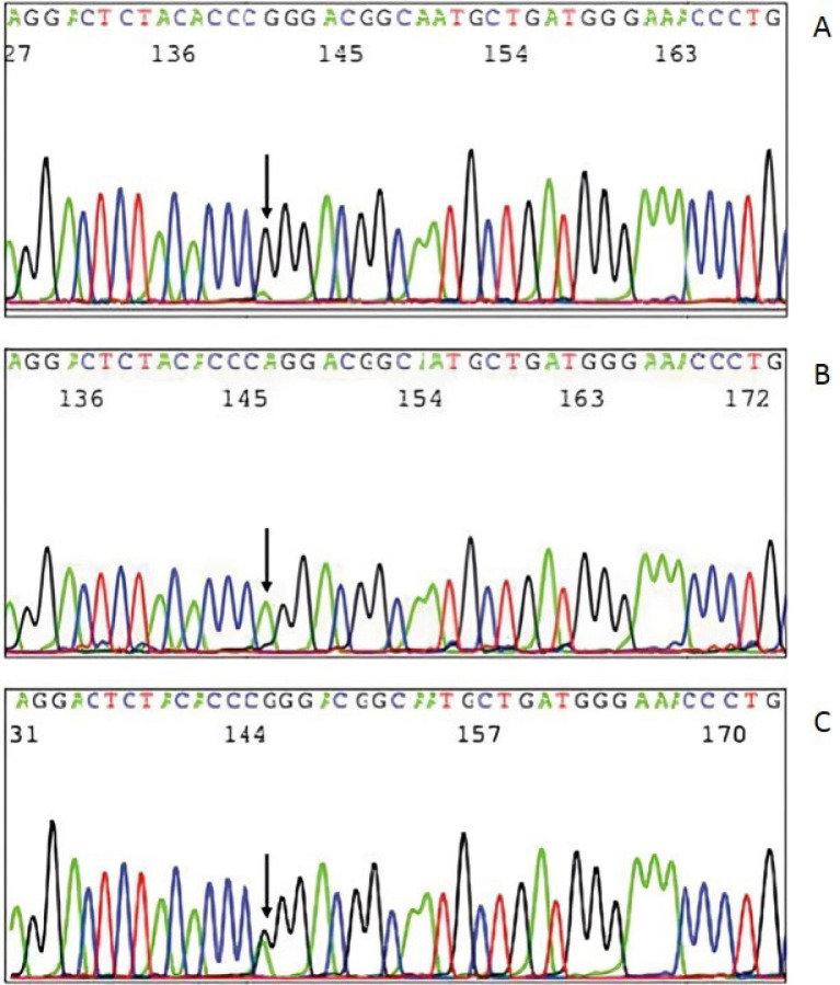 rs17576 polymorphism of matrix metalloproteinase-9 in predicting coronary artery disease severity and its adverse outcome.