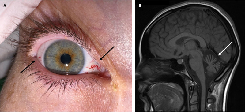 Ocular Telangiectasia and Cerebellar Atrophy in Ataxia-Telangiectasia (Louis-Bar Syndrome).