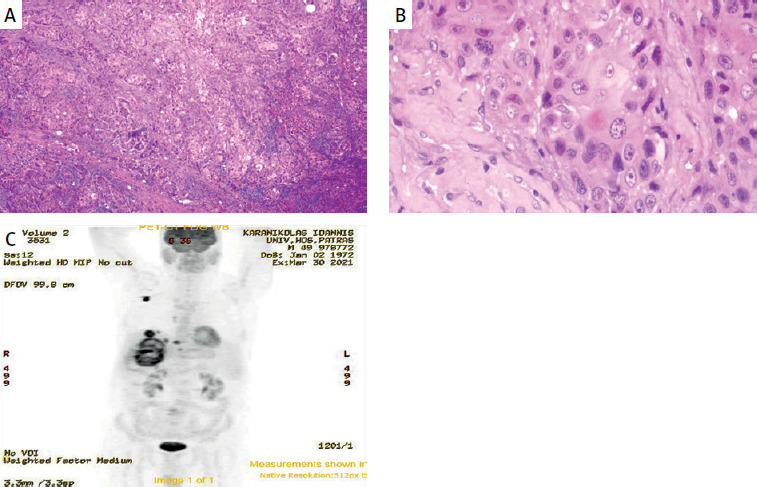 Primary squamous cell carcinoma of the liver.