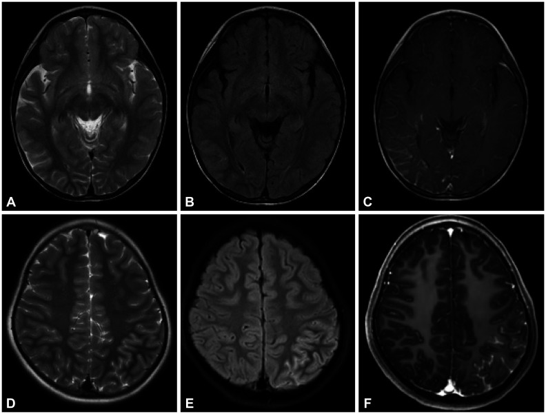 Phenotype of Relapsing Myelin Oligodendrocyte Glycoprotein Antibody-Associated Disease in Children.