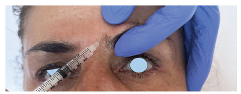 Anatomy, Etiology, Management, and Medico-Legal Implications of Botulinum-induced Blepharoptosis.
