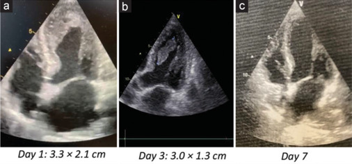 Stress Cardiomyopathy Complicated By Left Ventricular Thrombosis with Fatal Detachment.