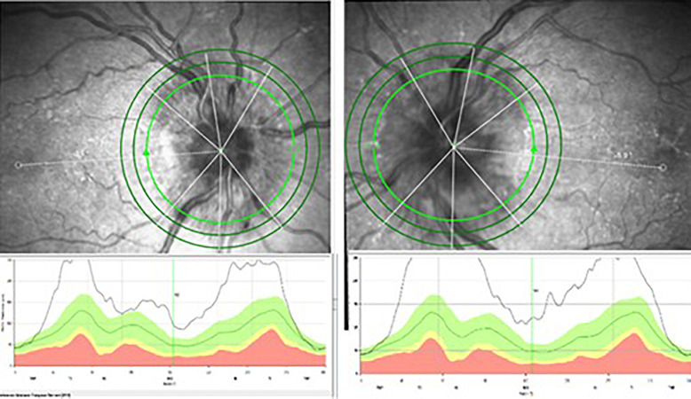 Bilateral Paraneoplastic Optic Neuropathy as the First Presentation of Preclinical Small Cell Lung Cancer: Case Report.
