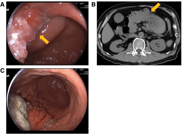 Gastroduodenal Intussusception with Gastric Adenocarcinoma: A Case Report and Review of the Literature.