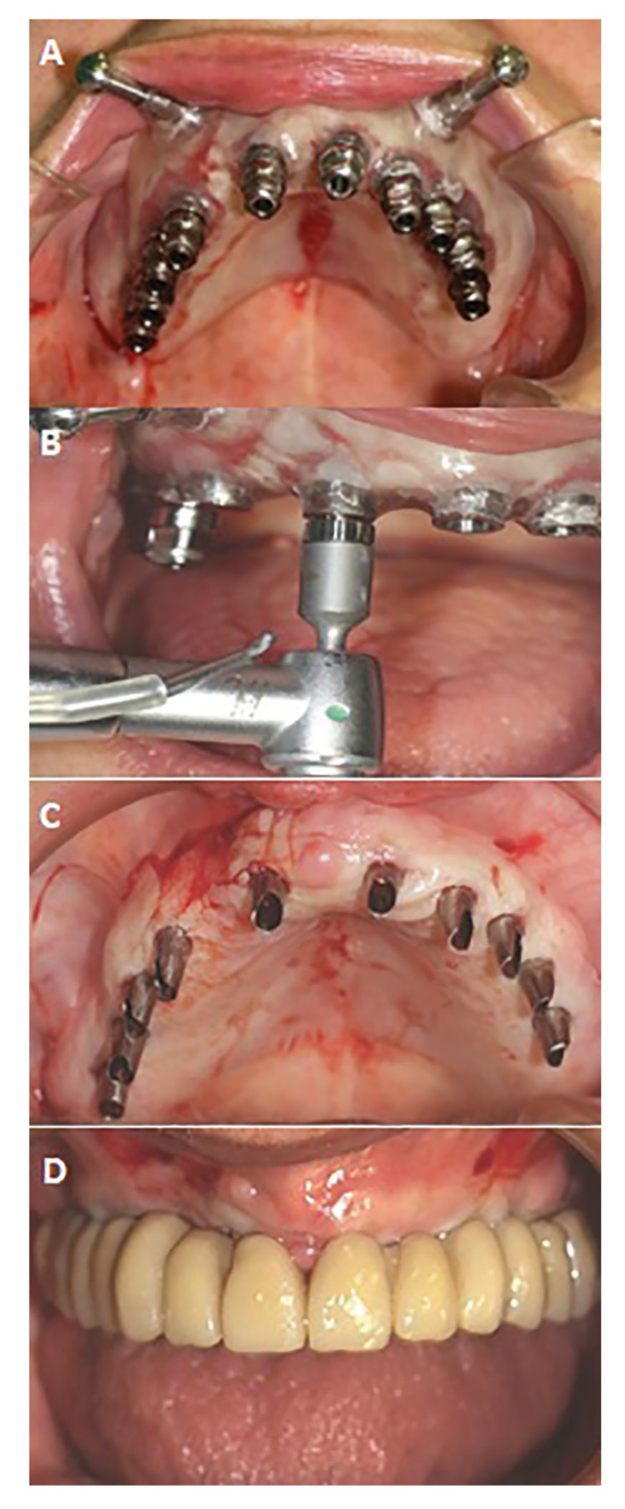 Retrospective clinical follow-up of implants placed in edentulous jaws after computer-guided surgery and immediate loading, in geriatric patients.