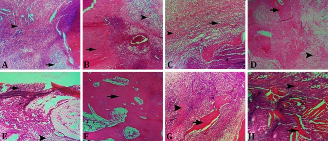 Evaluation of effects of vancomycin/polycaprolactone nanocomposite in comparison with curcumin/polycaprolactone on the healing of experimental osteomyelitis in rabbit tibia.