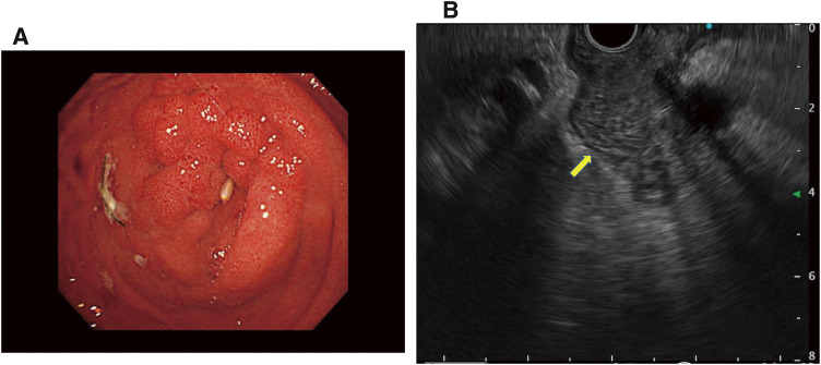 A Rare Case of Ampullary Carcinoma with Complete Duodenal Obstruction as the Initial Manifestation.
