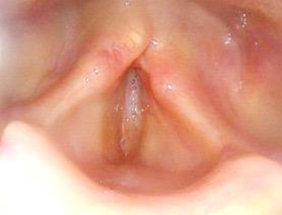 Laryngeal Frame Involvement as The First Sign of Wegener's Granulomatosis.