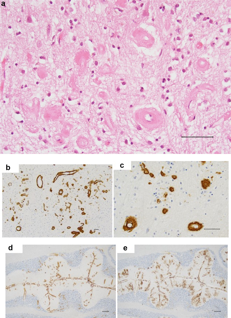 A de novo, mosaic and complex chromosome 21 rearrangement causes APP triplication and familial autosomal dominant early onset Alzheimer disease.