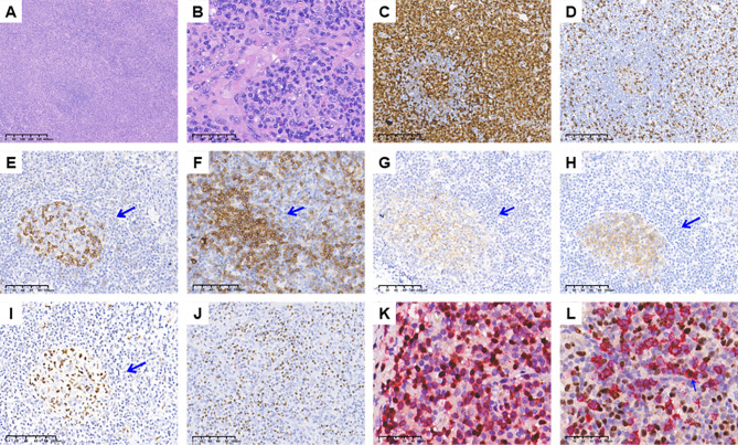 An exploratory study on the differential diagnostic indicators between adult systemic EBV-positive T-cell lymphoproliferative disorders and angioimmunoblastic T-cell lymphoma with multiple EBV infections.