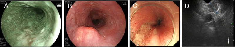 Occult synchronous multiple primary esophageal squamous cell carcinoma with mediastinal metastasis (with video).