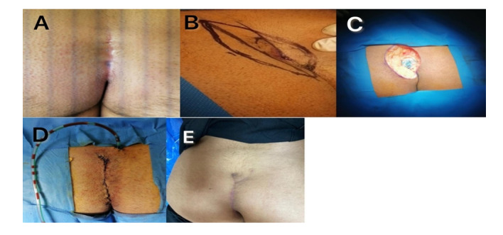 Karydakis Flap as a Simple Surgical Method in the Treatment of Pilonidal Disease V.S Open Surgery with Average 30-month-follow up: A Clinical Trial.