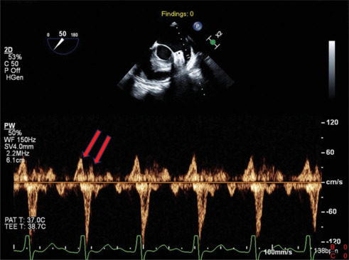 Decoding the Rhythm: The Additive Value of Left Atrial Appendage Flow in the Diagnosis of Atrial Tachyarrhythmias.