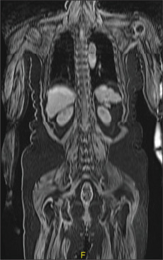 Autoimmune Encephalitis Pattern on PET-MRI in a Patient with Amyotrophic Lateral Sclerosis.