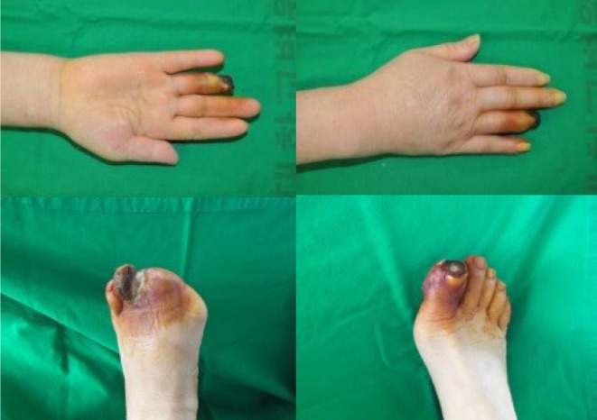 Determining the timing and extent of amputation in symmetrical peripheral gangrene: a report of three cases from Korea.