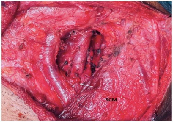Fenestration and Bifurcation of the Internal Jugular Vein; Surprises During Head and Neck Surgery.