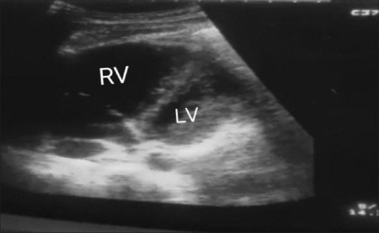 A Comprehensive Clinical Acumen Enhanced by Point-of-Care Ultrasonography in Managing Acute Life-Threatening Massive Pulmonary Thromboembolism in a Peripheral Setting: A Case Report.