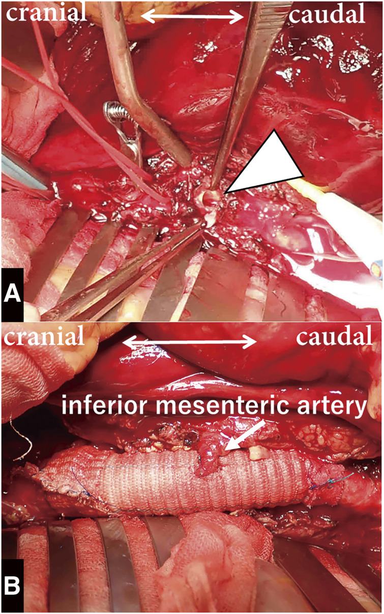 Rupture of the Abdominal Aorta without Aneurysm Associated with Giant Cell Arteritis: A Case Report.