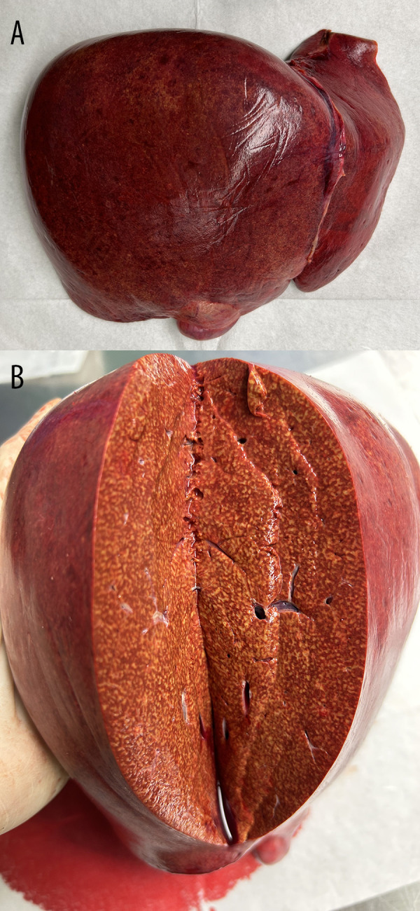 Survival Analysis of Liver Transplants in Patients with Acute Liver Failure from Acetaminophen and Mushroom Toxicity.