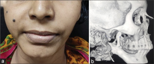 Tubercular osteomyelitis of mandible: Defining diagnostic criteria.