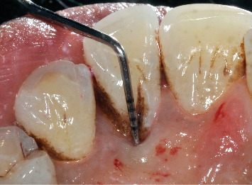 Successful Management of Palatal Developmental Groove-Associated Periodontal Defect Using Palatal Access Flap and Odontoradiculoplasty: A Case Report.