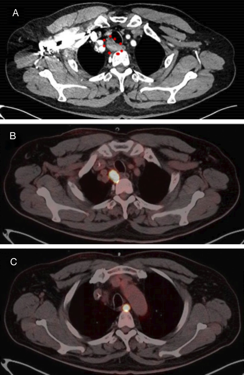 Occult synchronous multiple primary esophageal squamous cell carcinoma with mediastinal metastasis (with video).