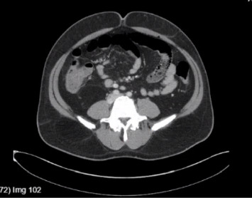 Typhoid Fever as a Cause of Liver Failure in the United States: A Case Report.