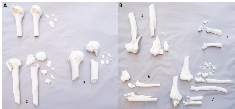 3D Printed Models of Periarticular Fractures of the Shoulder and Elbow Improve Surgical Decision Making in Orthopedic Trainees.