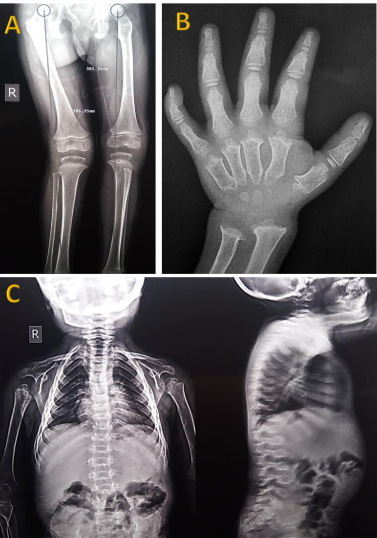 A Novel Missense Mutation of c.965C>T (p.Ala322Val) in the Human <i>GALNS</i> Gene Results in Severe Mucopolysaccharidosis Type IVA.