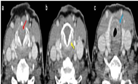 Laryngeal Frame Involvement as The First Sign of Wegener's Granulomatosis.