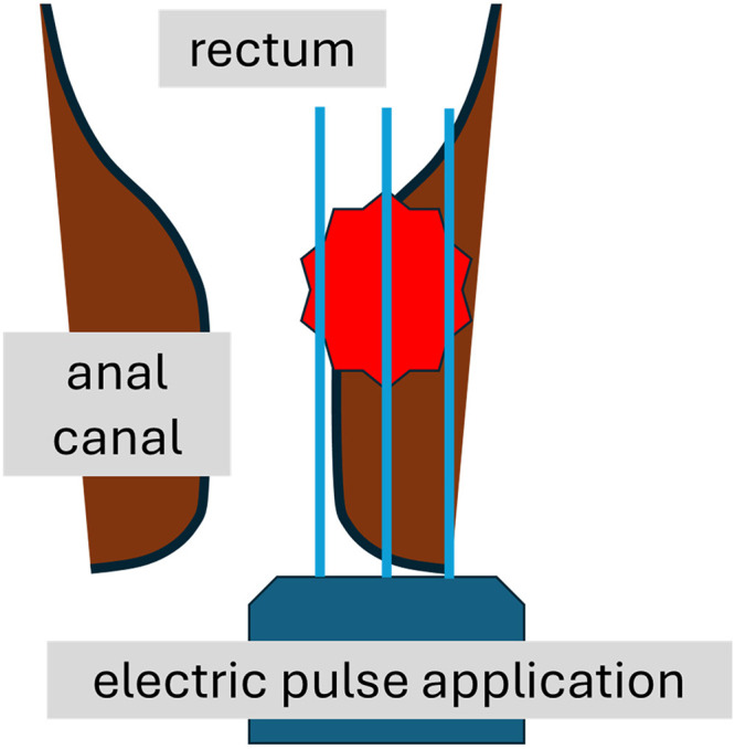 Electrochemotherapy for Anorectal Tumors: A Narrative Literature Review.