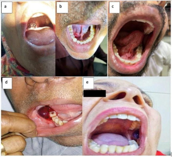 Epidemiology of Angina Bullosa Hemorrhagica: A Retrospective study.