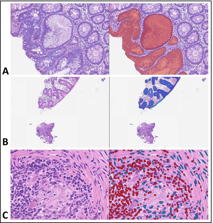 Evaluating the pathological and clinical implications of errors made by an artificial intelligence colon biopsy screening tool.